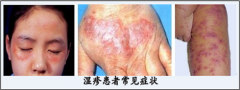 【湿疹】“中医综合疗法”扫除湿