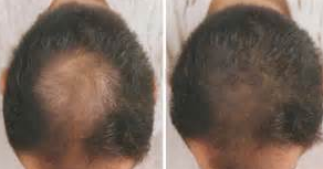 脱发的发生给患者心理造成的影响是什么