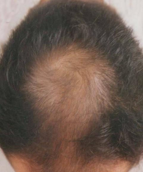 脱发的常见症状有哪些