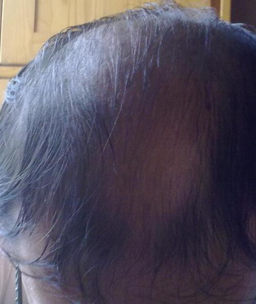 郑州脂溢性掉发的症状表现是什么