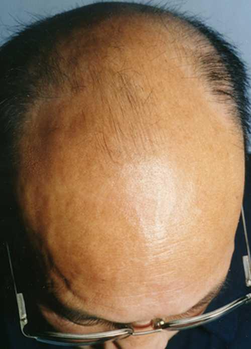 郑州脂溢性脱发有哪些症状表现