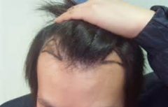 郑州如何治疗脂溢性脱发