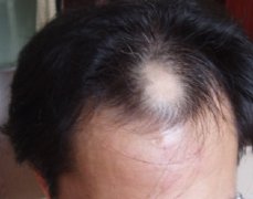 郑州哪里看脱发较好,脱发的病因