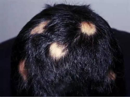 脂溢性脱发的患病原因是什么